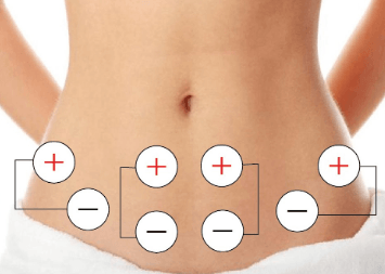 Colocacion de electrodos en abdomen inferior para electroestimulaci贸n