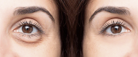 antes y después tratamiento bolsas de los ojos