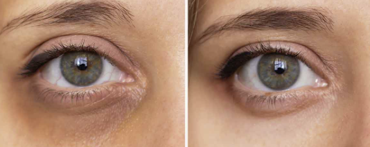 imagen ejemplo ojeras antes y después