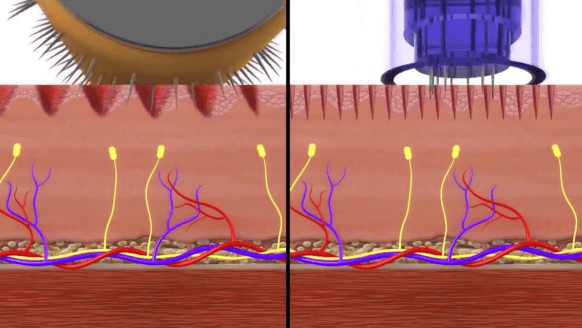 Dermapen y dermaroller. Imágenes en la piel