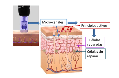 Como trabaja un dermapen en la piel